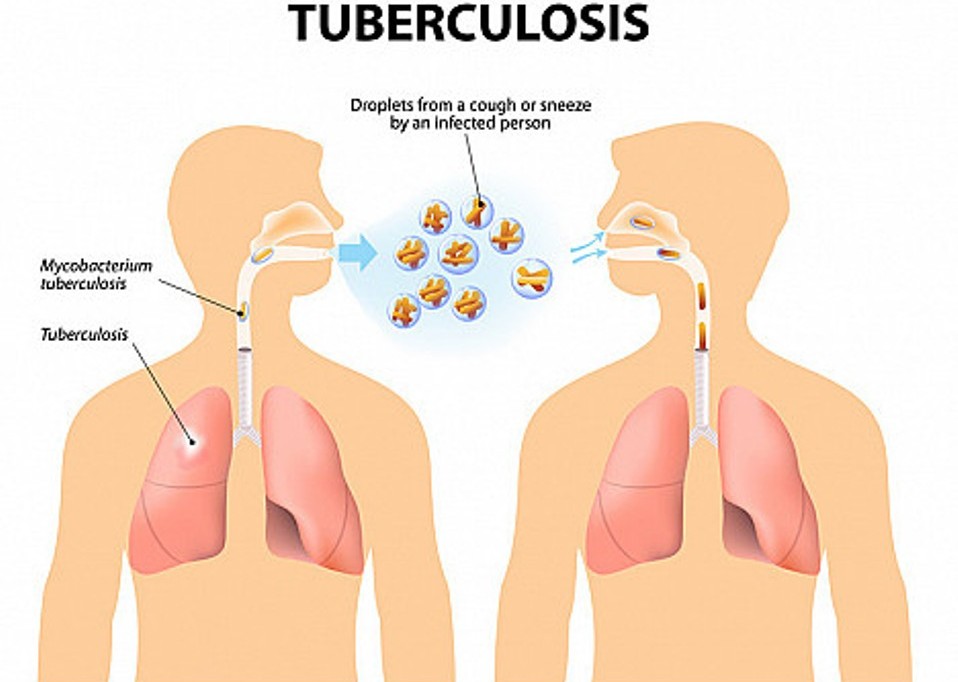 Civil Society and Media Push for Urgent Action on TB Funding Gap in Imo State