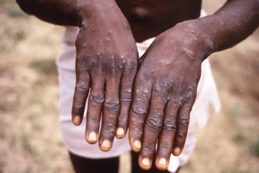 Mpox Crisis: What You Need to Know About the Rapidly Spreading and Deadly New Variant