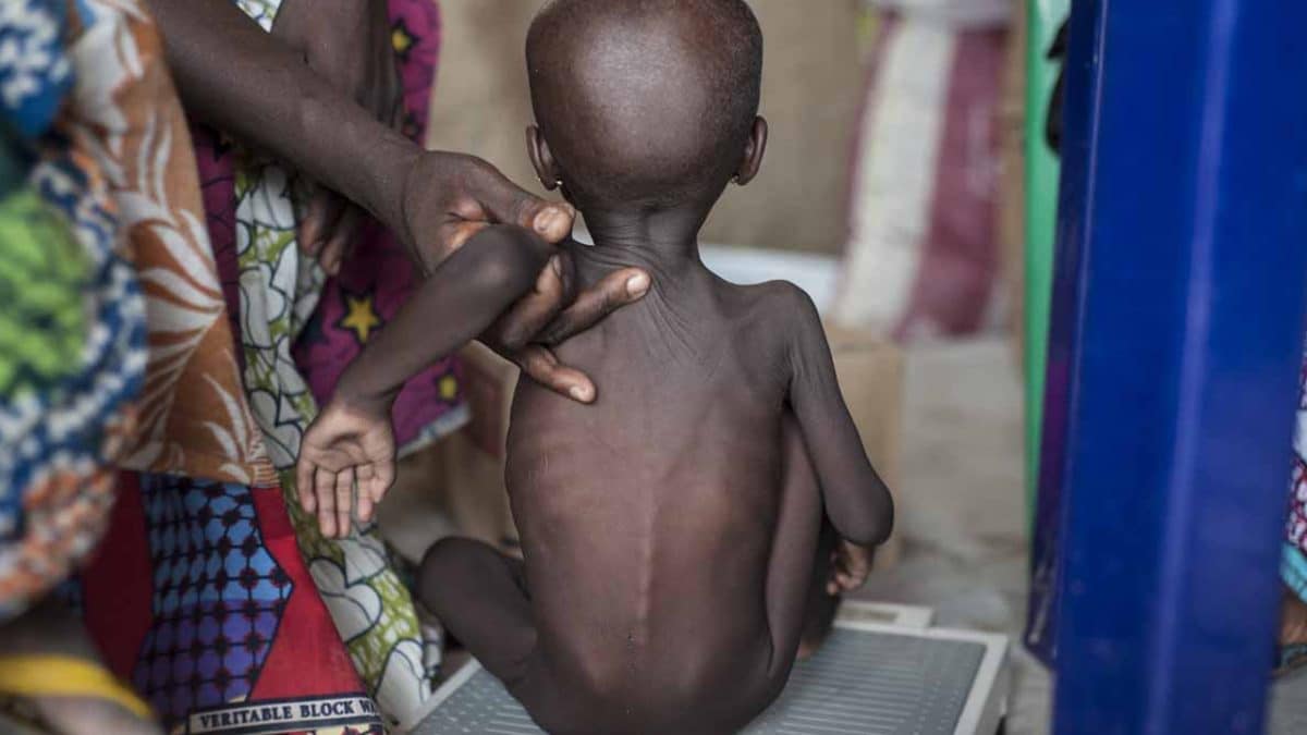 FG Confirms Over 4 Million Children Malnourished in Northeast and Northwest Amidst Worsening Hardship